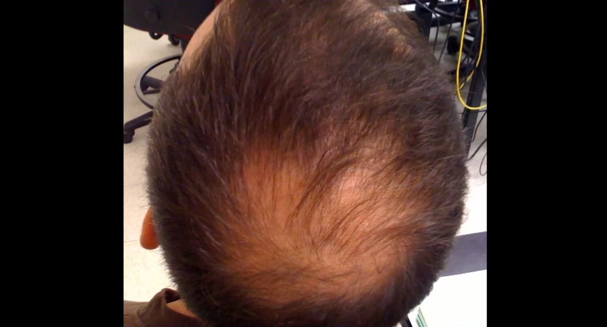 Welshsk; https://en.wikipedia.org/wiki/Hair_loss#/media/File:Alopecia.jpg