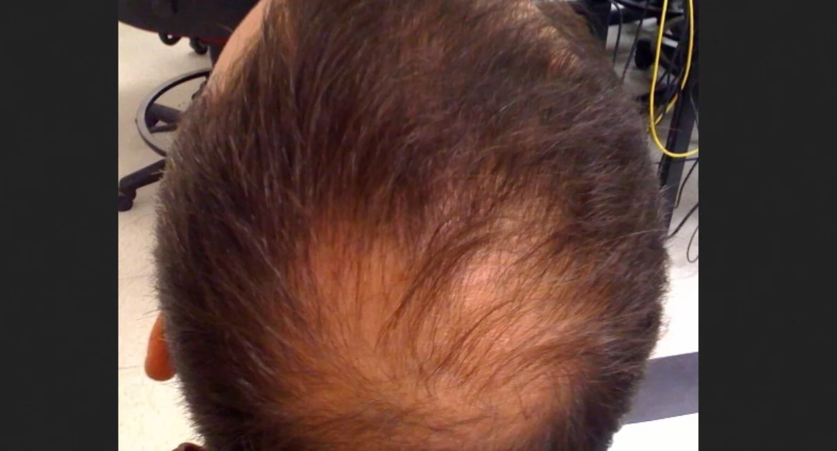 Òdj. Welshsk; zdrzódło: https://pl.wikipedia.org/wiki/%C5%81ysienie_androgenowe#/media/Plik:Alopecia.jpg